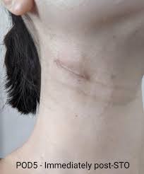 swollen lymph nodes in the neck dr