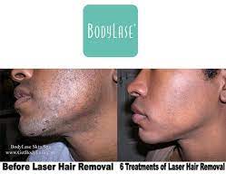 laser hair removal for african american