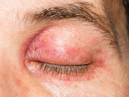 what you must know about shingles