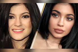 Kylie jenner before plastic surgery you can find fascinating photos! Lip Fillers Be Aware Of The Before And After Tricks Dtnext In