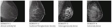 Breast Density Ultrasound Centura Health