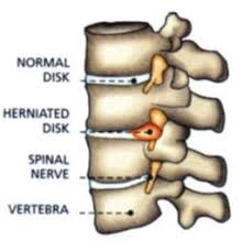 slipped disc treatment without surgery