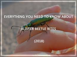 blister beetle bites