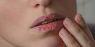 ways to treat chapped dry lips