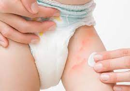 nappy rash treatment and prevention