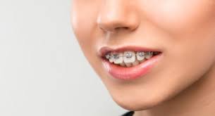 After that, you can expect your straightening make us your trusted ottawa orthodontist with our free consultation. How To Get Rid Of Braces Pain These 9 Tips Can Help