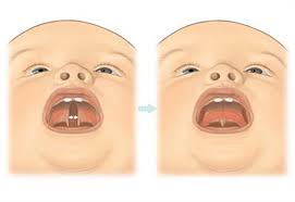 cleft lip palate healthier together