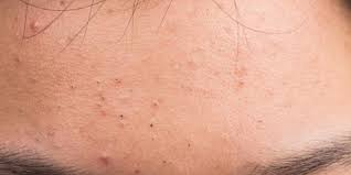 sweat pimples causes treatments