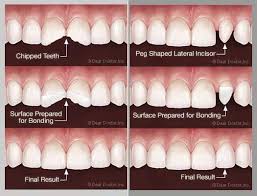 Dental insurance providers and policies differ as to the procedures they cover, how much they pay and under what circumstances. Pin Oleh Melissa Burroughs Di Cosmetic Bonding