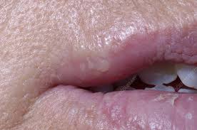 cold sores herpes simplex on the lips
