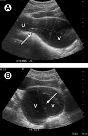 It typically is done in a male patient transrectally to look at the prostate or rectum. Ultrasound Of The Pediatric Female Pelvis Sciencedirect