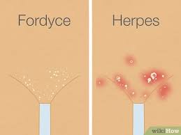 how to get rid of fordyce spots 12