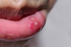 canker sore