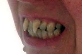 They look real, and as a bonus, because dental putty holds them in place, you can eat, drink, and talk normally. Woman Grows Vampire Fangs Leaving Her Too Afraid To Be Seen In Public Mirror Online