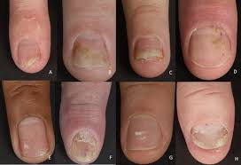 nail psoriasis a review of treatment