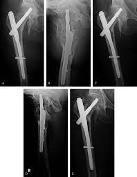 case 2 postoperative radiograph with