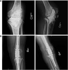 outcomes of modular knee arthrodesis