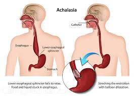 achalasia a us nerve disorder and