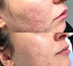 acne treatment bwood scarring