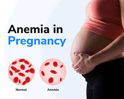 anaemia during pregnancy causes