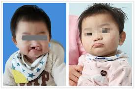 baby born with cleft lip