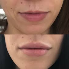 lip injections edgewater med spa
