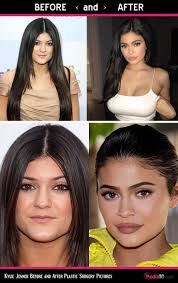 She's harnessed her family's fame to launch. Kylie Jenner Before And After Face Kylie Jenner Before And After Kylie Jenner Plastic Surgery Kylie Jenner Lips Kylie Jenner Face