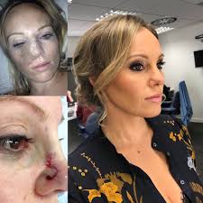 From wikipedia, the free encyclopedia. Michelle Dewberry On Twitter 2014 I Had Skin Cancer On Face I Had Mohs Surgery To Cut It Out Skin Stretched Stitched Over I Was So Paranoid About What It Wld Look