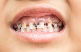 Knowing the right methods and tools to correctly brush your teeth with braces will help you avoid cavities, teeth falling out and other dental problems. Tooth Decay In Kids Signs Of Cavities And Treatment Options Absolute Dental