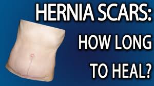 hernia scar tissue how long to heal