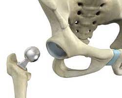 partial hip replacement warrnambool