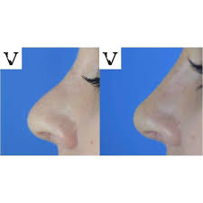 how this nose job without surgery can