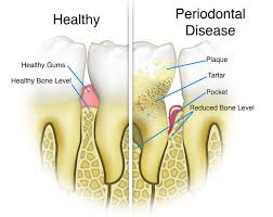 periodontal disease gum disease