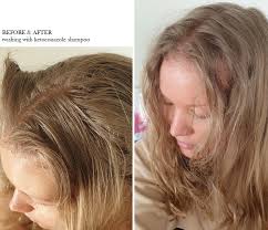 scalp problems seborrheic dermais