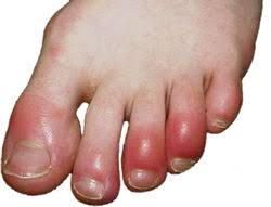I broke my pinkie toe and nothing i did provided relief or stability. How To Tell If My Pinky Toe Is Broken Or Sprained Quora