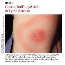 recognizing lyme disease