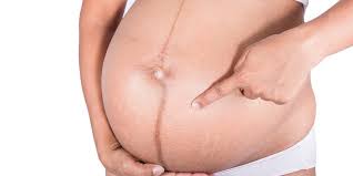 It involves clamping or sealing the fallopian tubes. Linea Nigra What Is That Pregnancy Line Explained