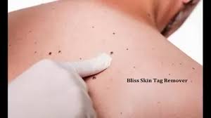 (Warnings) Bliss Skin Tag Remover Reviews Shocking DANGER REVEAL Need To  Know