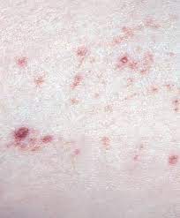 Purpura rash the rash that is associated with purpura is sometimes referred to as either skin hemorrhages or blood spots. Diagnosing Rashes Part 7 Purpuric Rashes Practice Nursing