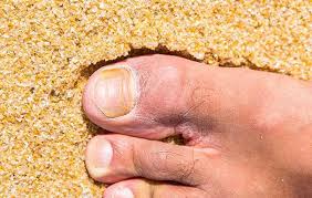 12 warning signs of an infected toenail