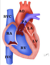 When should someone seek medical care. Morphological Changes Of The Heart In Massive Pulmonary Embolism Pe Download Scientific Diagram