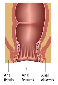 abscess colon rectal