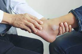 physical therapy after ankle surgery