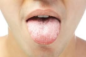 dry mouth causes symptoms prevention