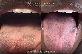 dark spots on tongue laser ny