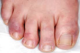 The cause and condition may differ from person to person. How To Treat Chilblains At Home The Footcare Clinic