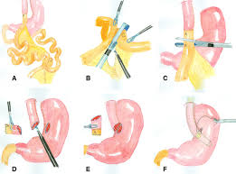 laparoscopic reversal of roux en y