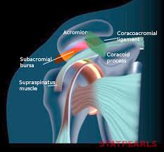 A sacroiliac joint injection is designed to diagnose and treat pain and inflammation from sacroiliac jo. Subacromial Bursitis Article