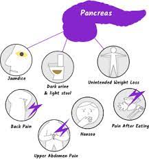 Many symptoms of pancreatic cancer are mild at first, so patients may often be unaware of the potential seriousness of them. Symptoms Of Pancreatic Cancer Managing Pancreatic Cancer Let S Win