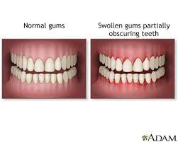 gums swollen information mount